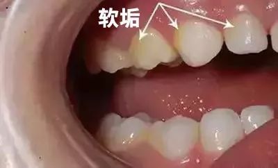 children's teeth Caries Tartar